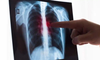 Mengenal Pneumonia Aspirasi, Gejala, Penyebab dan Cara Mengobatinya